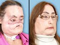 Connie Culp's groundbreaking face transplant was the first of it's kind in the US. Check out more at News.HealthGuru.com