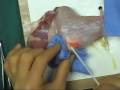 Abscess drainage