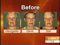 Dr. Antell, a top NYC plastic surgeon, is interviewed on the Today Show with a set of identical triplets.  He recently gave all three of them facelifts.
