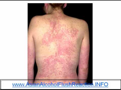 AsianGlow - Do you get Asian Glow and Asian Glow symptoms when you drink alcohol? http://www.asianalcoholflushreaction.info If you have an Asian Glow you will experience...