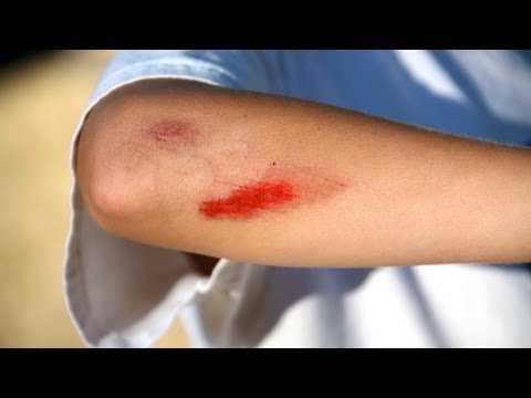 how to treat grazes