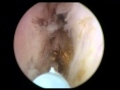 Prostate Enucleation - Laser Technique Prostate Enucleation - Laser Technique