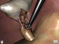Simulated Cholecystectomy