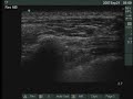 Ultrasound-Guided Thoracic Paravertebral Block Ultrasound-Guided Thoracic Paravertebral Block