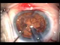 Pterygium Excision, Mitomycin C, Phaco UGA Pterygium Excision, Mitomycin C, Phaco UGA