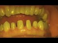 Surpass for Veneer Bonding Surpass for Veneer Bonding