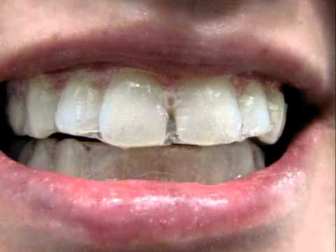 how to whiten tpu