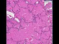 Histopathology Lung --Alveolar proteinosis Histopathology Lung --Alveolar proteinosis