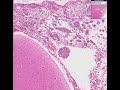 Histopathology Brain --Acute pyogenic (bacterial) meningitis