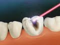Dental Cavity Removal