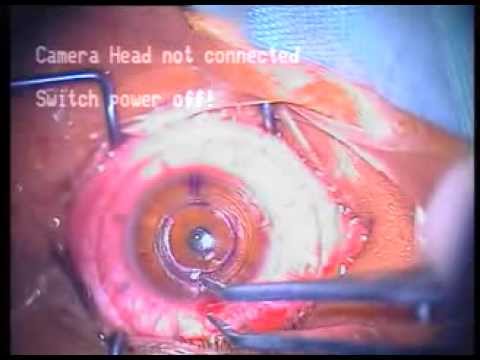 how to cure keratoconus