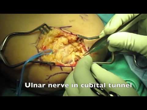 how to relieve cubital tunnel syndrome