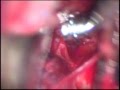 Brain Aneurysm Surgery (left VA-PICA), Ανεύρυσμα Εγκεφάλου (Thrace-Greece)