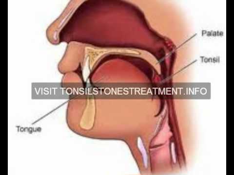 how to cure tonsil stones