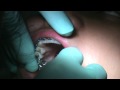 Palatal Orthodontic Anchor (intrusion) placement