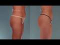 Dr Newall Body Contouring