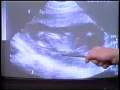 aborto video 3