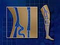 What Causes Varicose Veins?