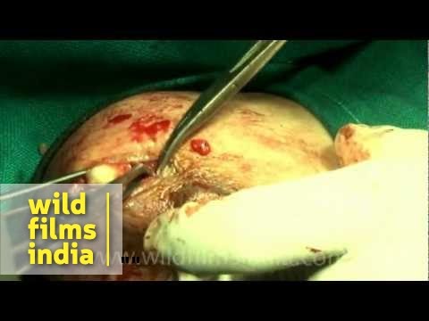 how to drain cyst in breast