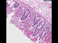 Histopathology Colon--Ischemic enterocolitis Histopathology Colon--Ischemic enterocolitis