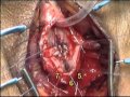 Buccal Mucosa Graft - Bulbar Urethral Reconstruction Buccal Mucosa Graft - Bulbar Urethral Reconstruction
