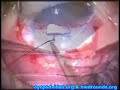 Mitomycin C Trabeculectomy & Trabeculotomy in Glaucoma