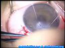 Mitomycin C Trabeculectomy & Trabeculotomy in Glaucoma