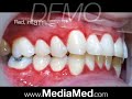 Teeth Cleaning, Brushing and Flossing-Dental