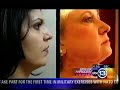 Mesotherapy Lipodisolve non surgical fat removal Mesotherapy Lipodisolve non surgical fat removal