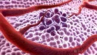 3D Medical Animation - What is Cancer?