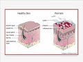 Psoriasis