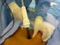 Visiport insufflation in cholecystectomy Visiport insufflation in cholecystectomy