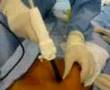 Visiport insufflation in cholecystectomy