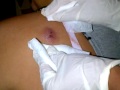 pus con sangre