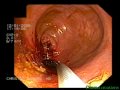 Stent Implantation In Colorectal Stenosis - Cancer Stent Implantation In Colorectal Stenosis - Cancer