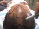 hair-transplant-dallas-educational-lecture-5.html