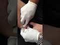 Draining an infected ingrown hair