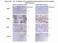 Project CXCR4 and Mantel Cell.avi