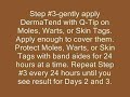 skin-tags-moles-warts-image-video-natural-nonsurgical.html