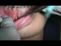 Lower anterior skeletal anchor placement, part 2, pilot hole