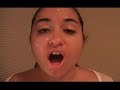Get rid of Pimples....FAST!!