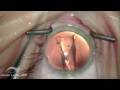 Visian ICL: High Definition Intraocular Contact Lens