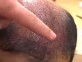 hair-transplant-educational-lecture-1.html