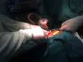 cirurgia bulco maxilo