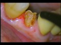 The nerve of a front tooth