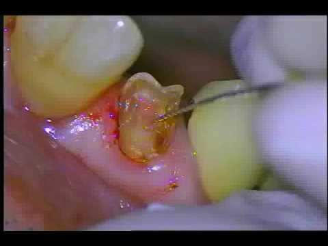 how to whiten a tooth with a dead nerve