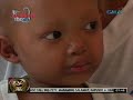 Magkakapatid, 'di pinagpapawisan dahil sa sakit na hypohidrotic ectordermal dysplasia