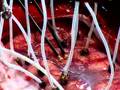 Live Webcast: Brain Surgery -Right Frontal Craniotomy