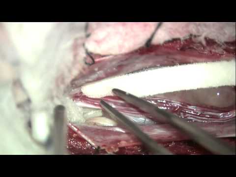how to relieve cauda equina