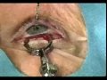 Chalazion Surgery